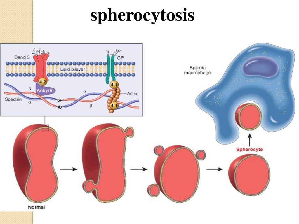 Hereditary spherocytosis asif new