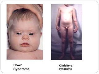 Down
Syndrome
Klinfelters
syndrome
 