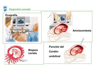 Diagnostico prenatal
Amniocentesis
Ecografia
Biopsia
coriala
Punción del
Cordón
umbilical
 