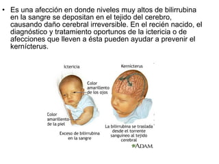 Es una afección en donde niveles muy altos de bilirrubina en la sangre se depositan en el tejido del cerebro, causando daño cerebral irreversible. En el recién nacido, el diagnóstico y tratamiento oportunos de la ictericia o de afecciones que lleven a ésta pueden ayudar a prevenir el kernícterus.  