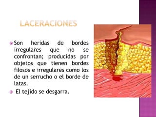 LaceracionesSon heridas de bordes irregulares que no se confrontan; producidas por objetos que tienen bordes filosos e irregulares como los de un serrucho o el borde de latas.  El tejido se desgarra.