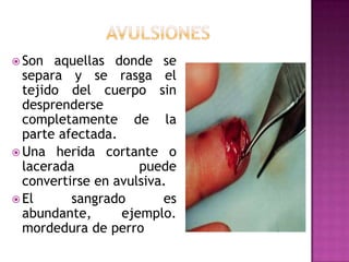 AvulsionesSon aquellas donde se separa y se rasga el tejido del cuerpo sin desprenderse completamente de la parte afectada.Una herida cortante o lacerada puede convertirse en avulsiva. El sangrado es abundante, ejemplo. mordedura de perro