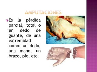 amputacionesEs la pérdida parcial, total o en dedo de guante, de una extremidad como: un dedo, una mano, un brazo, pie, etc.