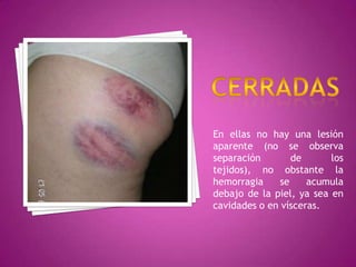 CERRADASEn ellas no hay una lesión aparente (no se observa separación de los tejidos), no obstante la hemorragia se acumula debajo de la piel, ya sea en cavidades o en vísceras.