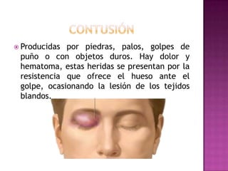 ContusiónProducidas por piedras, palos, golpes de puño o con objetos duros. Hay dolor y hematoma, estas heridas se presentan por la resistencia que ofrece el hueso ante el golpe, ocasionando la lesión de los tejidos blandos. 
