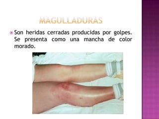 magulladurasSon heridas cerradas producidas por golpes. Se presenta como una mancha de color morado. 