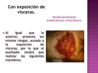 Con exposición de vísceras.Herida penetrante producida por arma blanca.Al igual que la anterior, presenta los mismos riesgos, aunada a la exposición de vísceras, por lo que el auxiliador tendrá que realizar las siguientes maniobras.