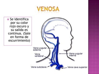 ARTERIALSe identifica por su color rojo brillante y la sangre sale conforme a las pulsaciones del corazón.