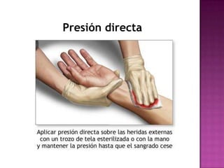 METODOS DE CONTENCIÓNPresión directaSe realiza con un apósito o gasa limpia colocándolo sobre la herida y presionando firmemente con la palma de la mano.Si la sangre pasa a través del apósito, no lo quites, aplica un segundo apósito y presiona con más fuerza.Existen cuatro métodos de contención