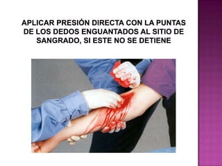 Control de hemorragia externa mediante presión directa