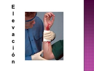 Elevación de la extremidadLa extremidad que presente una hemorragia intensa que no se contenga con los métodos anteriores, deberá elevarse por encima del nivel del corazón de la víctima, solo cuando no tenga alguna fractura.