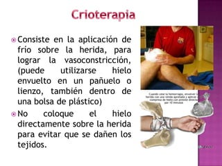 Puntos de Presión Femoral