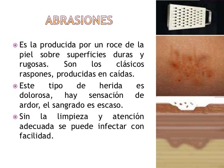 Heridas
