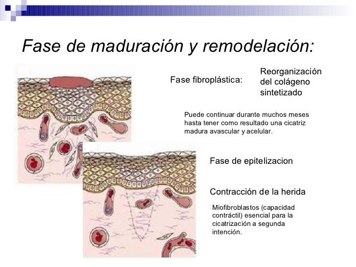 Heridas