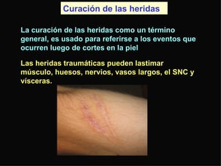 Curación de las heridas  La curación de las heridas como un término general, es usado para referirse a los eventos que ocurren luego de cortes en la piel Las heridas traumáticas pueden lastimar músculo, huesos, nervios, vasos largos, el SNC y vísceras.  