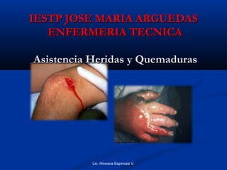 IESTP JOSE MARIA ARGUEDAS
ENFERMERIA TECNICA
Asistencia Heridas y Quemaduras

Lic. Hinosca Espinoza V.

 