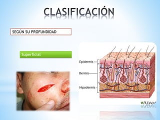 SEGÚN SU PROFUNDIDAD
Superficial
 