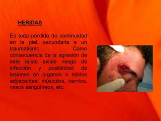 HERIDAS
Es toda pérdida de continuidad
en la piel, secundaria a un
traumatismo. Como
consecuencia de la agresión de
este tejido existe riesgo de
infección y posibilidad de
lesiones en órganos o tejidos
adyacentes: músculos, nervios,
vasos sanguíneos, etc.
 