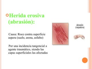 Herida erosiva
(abrasión):
Causa: Roce contra superficie
aspera (suelo, arena, asfalto)
Por una incidencia tangencial al
agente traumático, siendo las
capas superficiales las afectadas
 