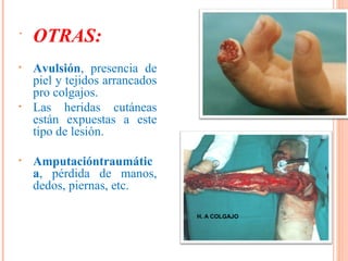  OTRAS:
• Avulsión, presencia de
piel y tejidos arrancados
pro colgajos.
• Las heridas cutáneas
están expuestas a este
tipo de lesión.
• Amputacióntraumátic
a, pérdida de manos,
dedos, piernas, etc.
H. A COLGAJO
 
