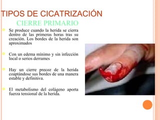 TIPOS DE CICATRIZACIÓN
 Se produce cuando la herida se cierra
dentro de las primeras horas tras su
creación. Los bordes de la herida son
aproximados
 Con un edema mínimo y sin infección
local o serios derrames
 Hay un cierre precoz de la herida
coaptándose sus bordes de una manera
estable y definitiva.
 El metabolismo del colágeno aporta
fuerza tensional de la herida.
CIERRE PRIMARIO
 