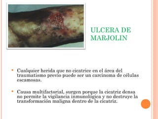 ULCERA DE
MARJOLIN
 Cualquier herida que no cicatrice en el área del
traumatismo previo puede ser un carcinoma de células
escamosas.
 Causa multifactorial, surgen porque la cicatriz densa
no permite la vigilancia inmunológica y no destruye la
transformación maligna dentro de la cicatriz.
 