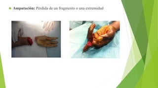  Amputación: Pérdida de un fragmento o una extremidad 
 