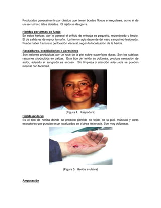 Producidas generalmente por objetos que tienen bordes filosos e irregulares, como el de
un serrucho o latas abiertas. El tejido se desgarra.
Heridas por armas de fuego
En estas heridas, por lo general el orificio de entrada es pequeño, redondeado y limpio.
El de salida es de mayor tamaño. La hemorragia depende del vaso sanguíneo lesionado.
Puede haber fractura o perforación visceral, según la localización de la herida.
Raspaduras, excoriaciones o abrasiones
Son lesiones producidas por un roce de la piel sobre superficies duras. Son los clásicos
raspones producidos en caídas. Este tipo de herida es dolorosa, produce sensación de
ardor, además el sangrado es escaso. Sin limpieza y atención adecuada se pueden
infectar con facilidad.
(Figura 4. Raspadura)
Herida avulsiva
Es el tipo de herida donde se produce pérdida de tejido de la piel, músculo y otras
estructuras que puedan estar localizadas en el área lesionada. Son muy dolorosas.
(Figura 5. Herida avulsiva)
Amputación
 