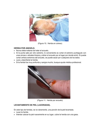 (Figura 10. Herida en cráneo)
HERIDA POR ANZUELO.
 Nunca debe tratarse de halar el anzuelo.
 Si la punta sale por otro extremo, lo conveniente es cortar el extremo puntiagudo con
unas pinzas o alicates limpios y retirar el anzuelo por el lugar por donde entró. Si puede
cortar ambos extremos del anzuelo, se puede sacar por cualquiera de los lados.
 Lave y desinfecte la herida.
 Si la herida fue muy profunda y sangra mucho, busque ayuda médica profesional.
(Figura 11. Herida por anzuelo)
LEVANTAMIENTO DE PIEL (LACERADAS).
En este tipo de heridas, se ve claramente, una porción de la piel levantada.
 Lavar la herida.
 Intentar colocar la piel nuevamente en su lugar, cubra la herida con una gasa.
 