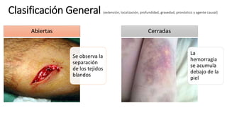 Clasificación General (extensión, localización, profundidad, gravedad, pronóstico y agente causal)
Se observa la
separación
de los tejidos
blandos
Abiertas
La
hemorragia
se acumula
debajo de la
piel
Cerradas
 