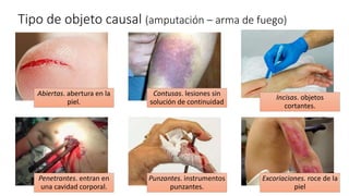 Tipo de objeto causal (amputación – arma de fuego)
Abiertas. abertura en la
piel.
Contusas. lesiones sin
solución de continuidad
Incisas. objetos
cortantes.
Penetrantes. entran en
una cavidad corporal.
Punzantes. instrumentos
punzantes.
Excoriaciones. roce de la
piel
 