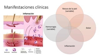 Manifestaciones clínicas Rotura de la piel
(variable)
Dolor
Inflamación
Hemorragia
(variable)
 
