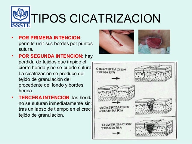 Heridas metodo enfermero