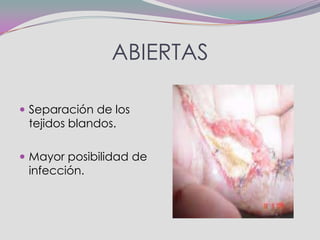 ABIERTAS

 Separación de los
 tejidos blandos.

 Mayor posibilidad de
 infección.
 