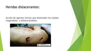 Heridas dislacerantes:
Acción de agentes lesivos que distienden los tejidos
rasgándolos o dislacerándolos.
 