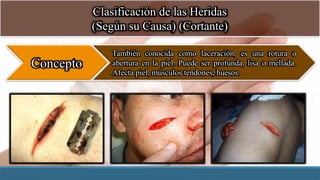 Clasificación de las Heridas
(Según su Causa) (Cortante)
Concepto
También conocida como laceración, es una rotura o
abertura en la piel. Puede ser profunda, lisa o mellada.
Afecta piel, músculos tendones, huesos.
 