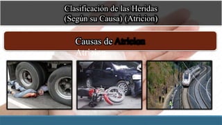 Clasificación de las Heridas
(Según su Causa) (Atricion)
Causas de
Atricion
 