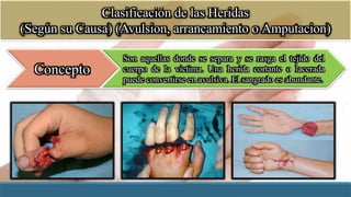 Clasificación de las Heridas
(Según su Causa) (Avulsion, arrancamiento o Amputacion)
Concepto
Son aquellas donde se separa y se rasga el tejido del
cuerpo de la víctima. Una herida cortante o lacerada
puede convertirse en avulsiva. El sangrado es abundante.
 