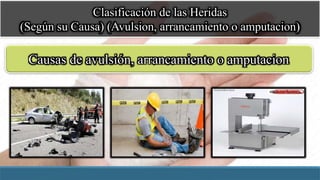 Clasificación de las Heridas
(Según su Causa) (Avulsion, arrancamiento o amputacion)
Causas de avulsión, arrancamiento o amputacion
 