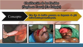 Clasificación de las Heridas
(Según su Causa) (En Colgajo)
Concepto
Este tipo de heridas presentan un fragmento de piel
unido al resto por un solo punto.
 