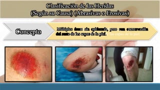 Clasificación de las Heridas
(Según su Causa) (Abrasivas o Erosivas)
Concepto
Múltiples áreas sin epidermis, pero con
conservación del resto de las capas de la piel.
 