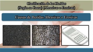 Clasificación de las Heridas
(Según su Causa) (Abrasivas o Erosivas)
Causas de Heridas Abrasivas o Erosivas
 
