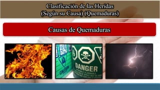 Clasificación de las Heridas
(Según su Causa) (Quemaduras)
Causas de Quemaduras
 