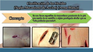 Clasificación de las Heridas
(Según Mecanismo de Accion) (Arma Blanca)
Concepto
Es una forma específica de traumatismo penetrante de la piel
que resulta de un cuchillo u objeto puntiagudo similar que es
"más profundo que ancho".
 