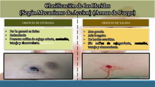 Clasificación de las Heridas
(Según Mecanismo de Accion) (Armas de Fuego)
ORIFICIO DE ENTRADA ORIFICIO DE SALIDA
• Mas grande.
• Más irregular.
• De bordes evertidos.
• Sinanillos de enjugamiento,
contusión,
tatuaje y ahumamiento.
• Por lo general es único
• Redondeado
• Presenta: anillos de enjuga miento,
contusión, tatuaje y ahumamiento.
 