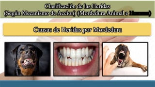 Clasificación de las Heridas
(Según Mecanismo de Accion) (Mordedura Animal o
Humana)
Causas de Heridas por Mordedura
 