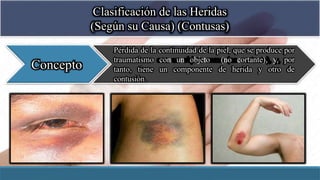Clasificación de las Heridas
(Según su Causa) (Contusas)
Concepto
Pérdida de la continuidad de la piel, que se produce por
traumatismo con un objeto (no cortante), y, por
tanto, tiene un componente de herida y otro de
contusión.
 