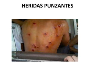 HERIDAS PUNZANTES
 