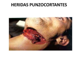 HERIDAS PUNZOCORTANTES
 