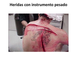 Heridas con instrumento pesado
 